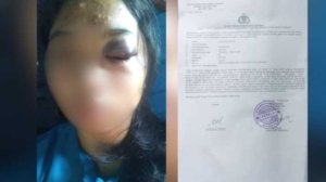 Siswa SMP Negeri 4 Tojo Diduga Dianiaya Kepsek Hingga Lebam, Keluarga Minta Keadilan