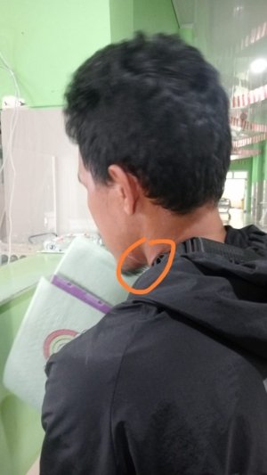Kabel PLN Tiba-tiba Turun, Pengendara Motor yang Melintas di Kolonodale Luka di Leher